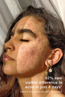 Skog Acne Clarifying Gel (30Ml)