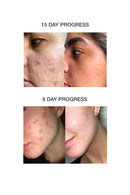 Skog Acne Clarifying Gel (30Ml)