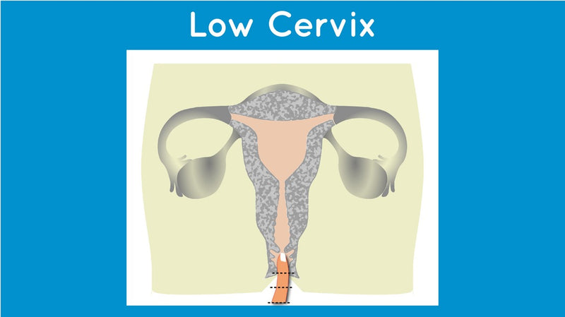 Low Cervix Menstrual Cup by Mermaid®(w/o box)